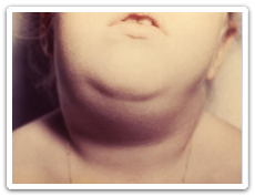 Partie avant du cou d’un jeune enfant qui montre l’enflure caractéristique attribuable au gonflement des glandes salivaires provoqué par les oreillons.